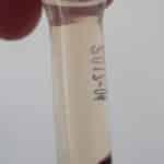 serum anémie 150x150